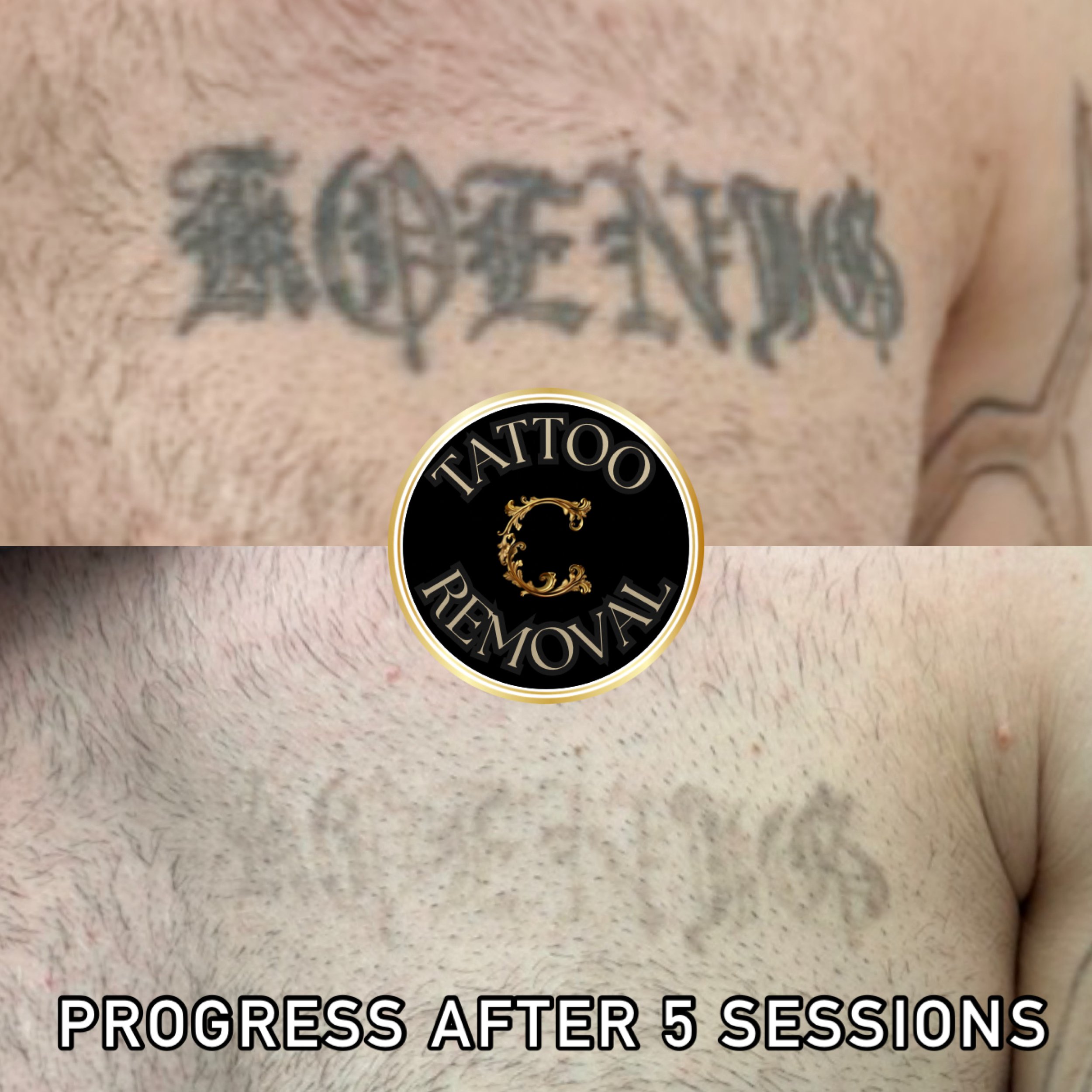 Dark tattoo fading back to original skin after 5 sessions of tattoo removal at Chariot Tattoo & Removal. 