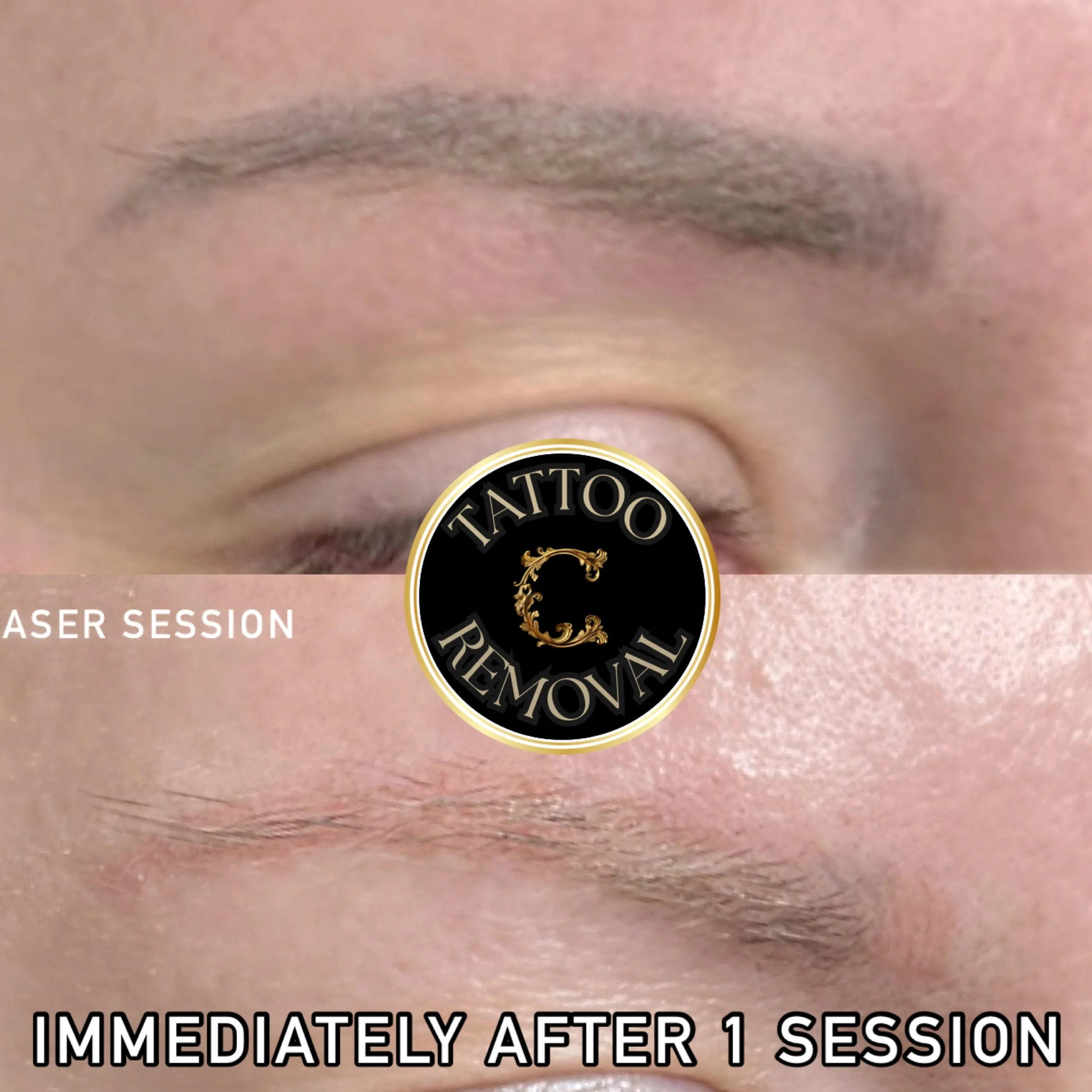 Before and after result from tattoo removal on old eyebrow tattoo showing incredible result and ink reduction. 