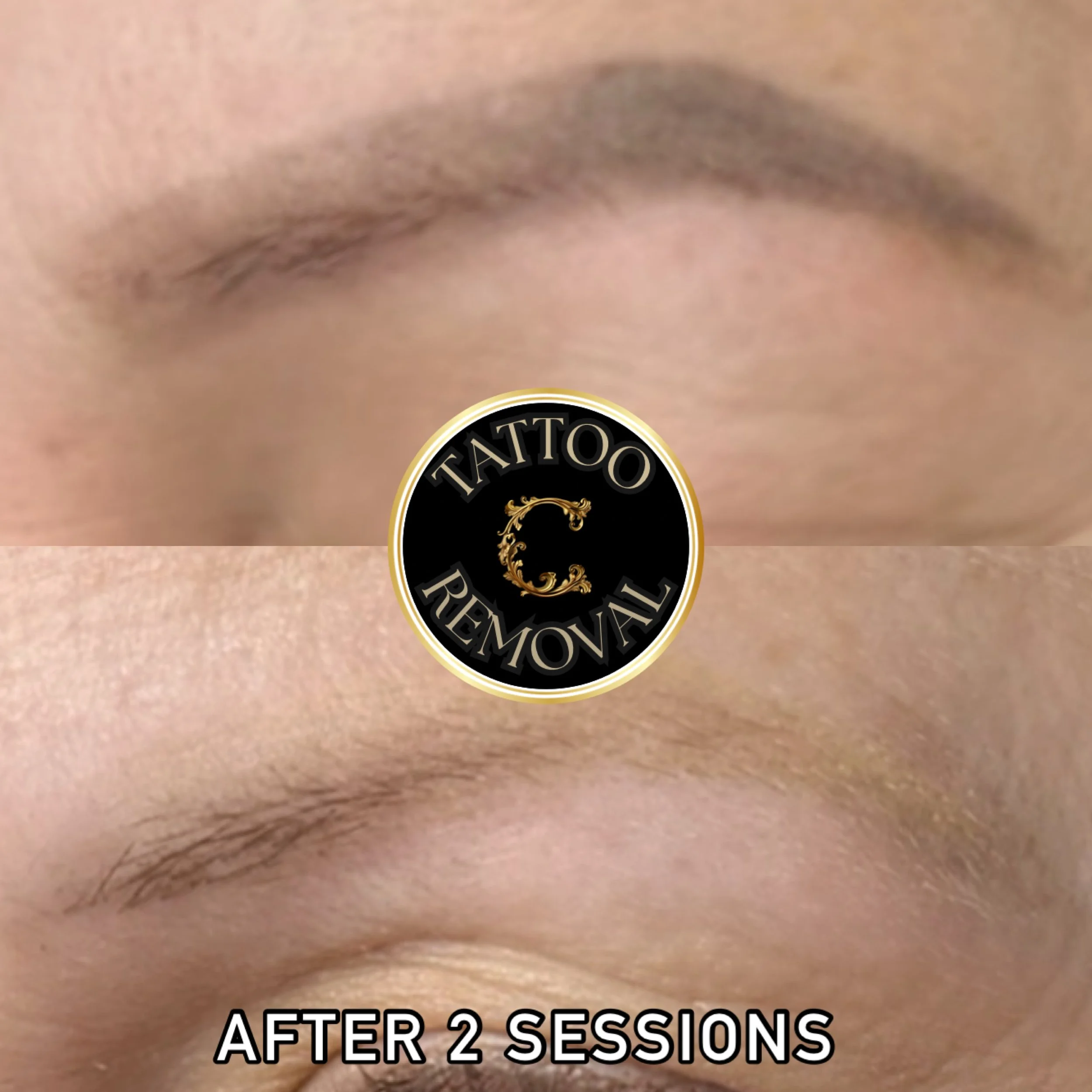 Eyebrow tattoo removal result on client showing 90% ink clearance in just two laser removal sessions. 