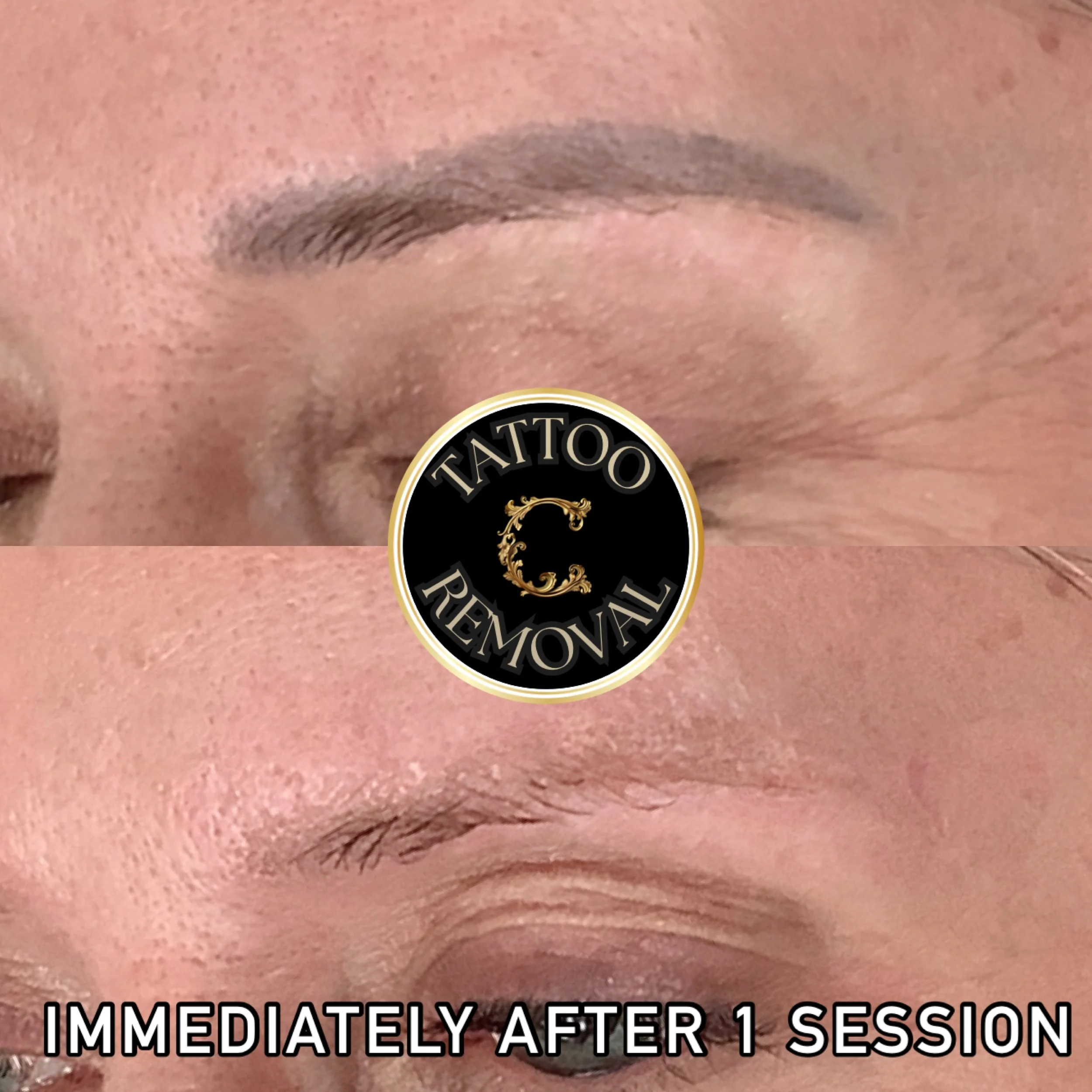 Dark unwanted microblading corrected with laser tattoo removal and clients eyebrows returned back to skin tone. 