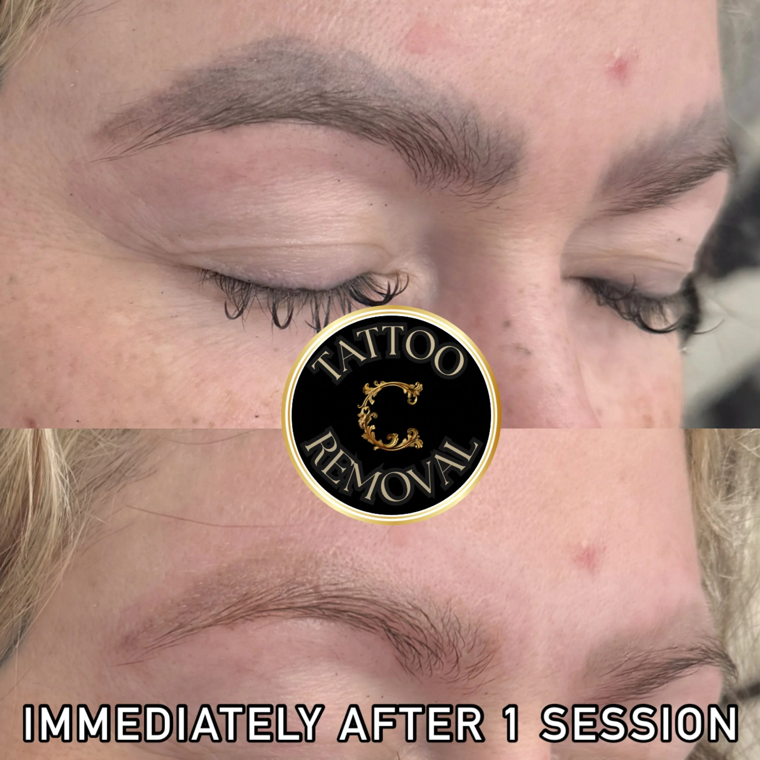 Thick botched microblading more than half way removed after just one session of laser tattoo removal with the Candela Picoway. 