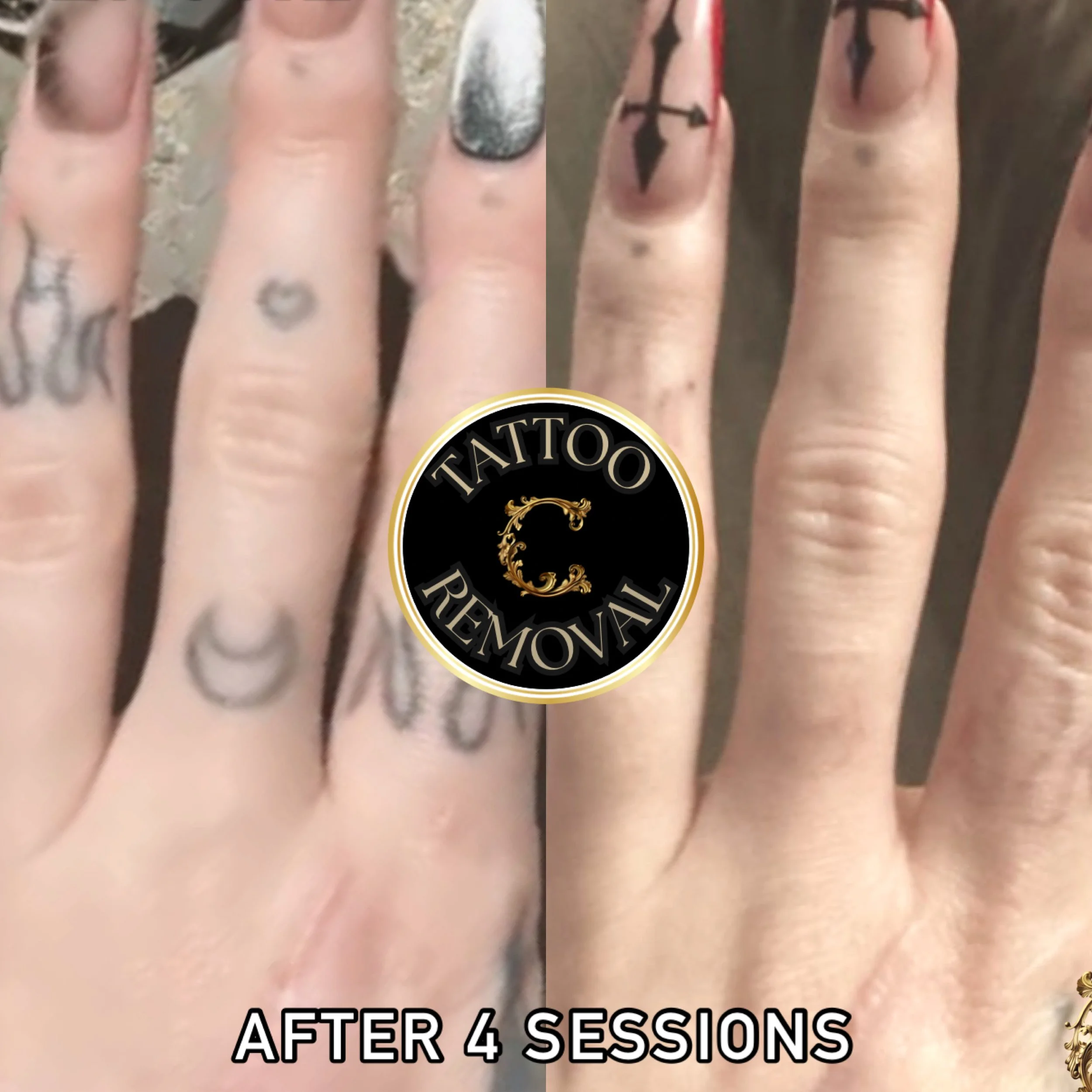 Progress photo during laser tattoo removal process of finger tattoos fading away after 4 treatments .