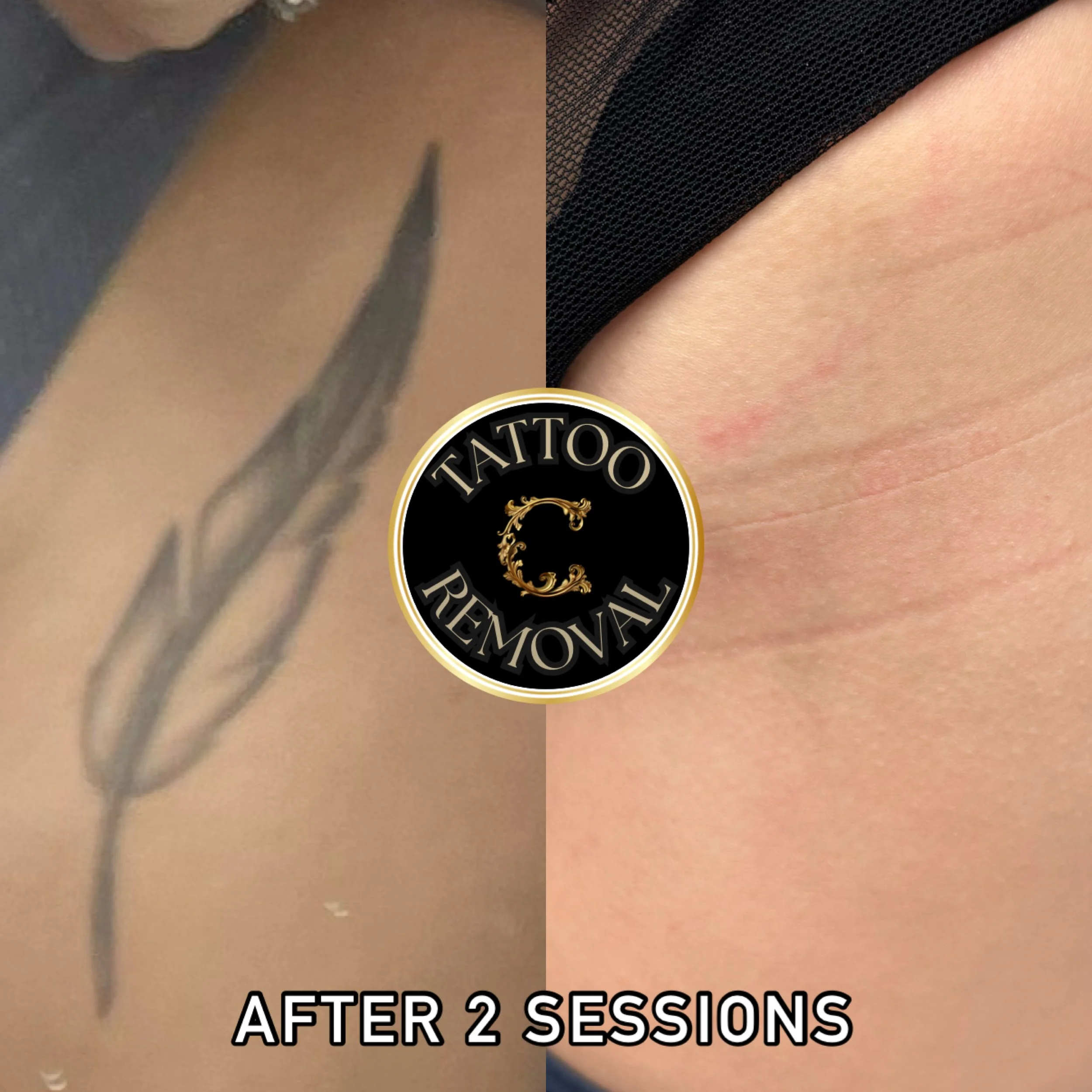 Before and after of laser tattoo removal of feather on ribs after just 2 sessions. 