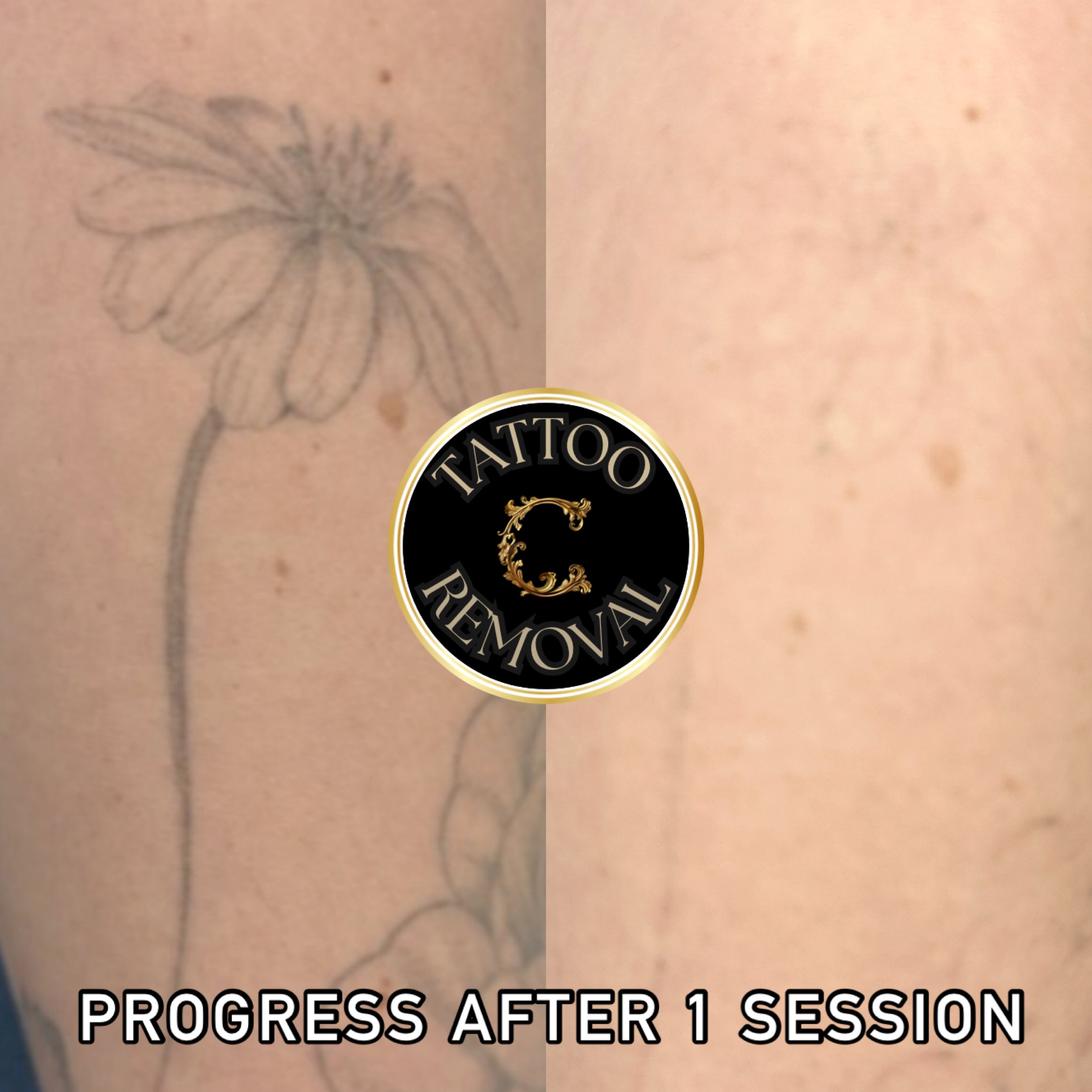 Flower tattoo fading into skin with no scarring or hypopigmentation after successful laser tattoo removal. 