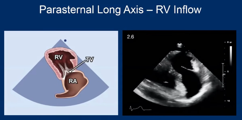 RV inflow view — Pulmonary POCUS