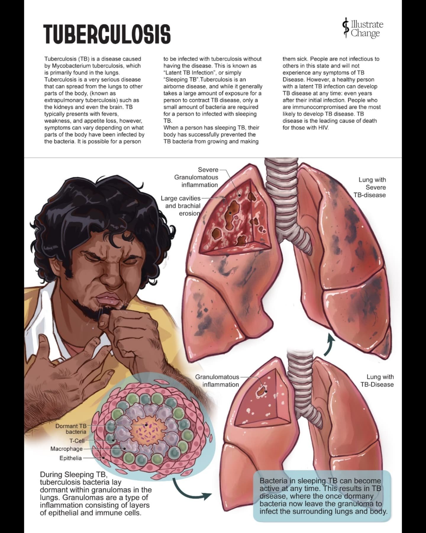My illustration featuring pulmonary tuberculosis that was completed as part of my fellowship for @amidotorg (sponsored by @jnj )
.
.
.
.
.
.
.
The more I learn about tuberculosis, the more of come to appreciate the complexity of this unique disease.