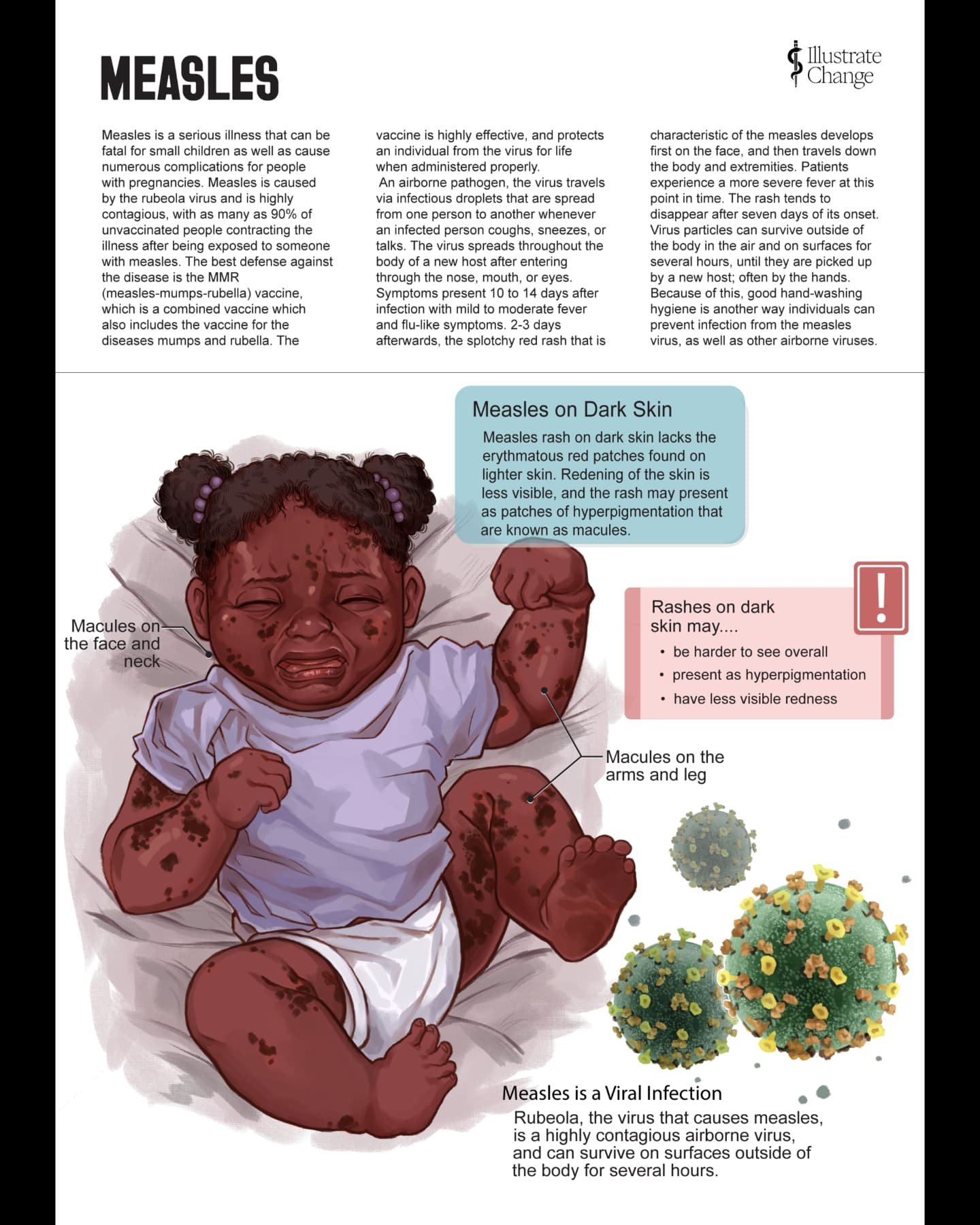 My Measles spread for the AMI fellowship. @amidotorg
The appearance of the #Measles rash on dark skin can look a lot different than the conventional signifiers on dark skin. The trademark rosatia of Measles may be lesser or even missing entirely, wh