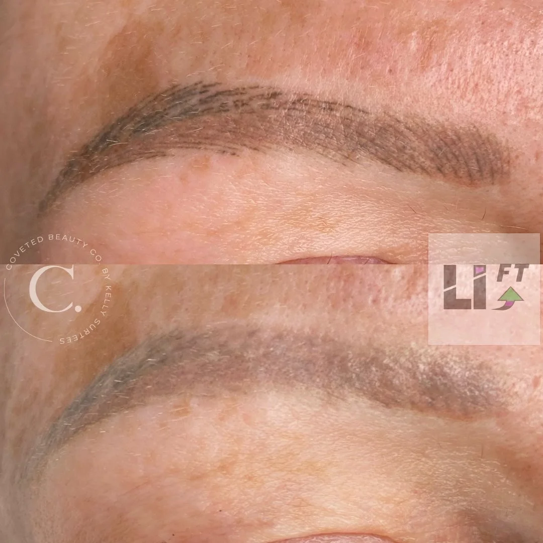 Lift Tattoo Removal Norwich