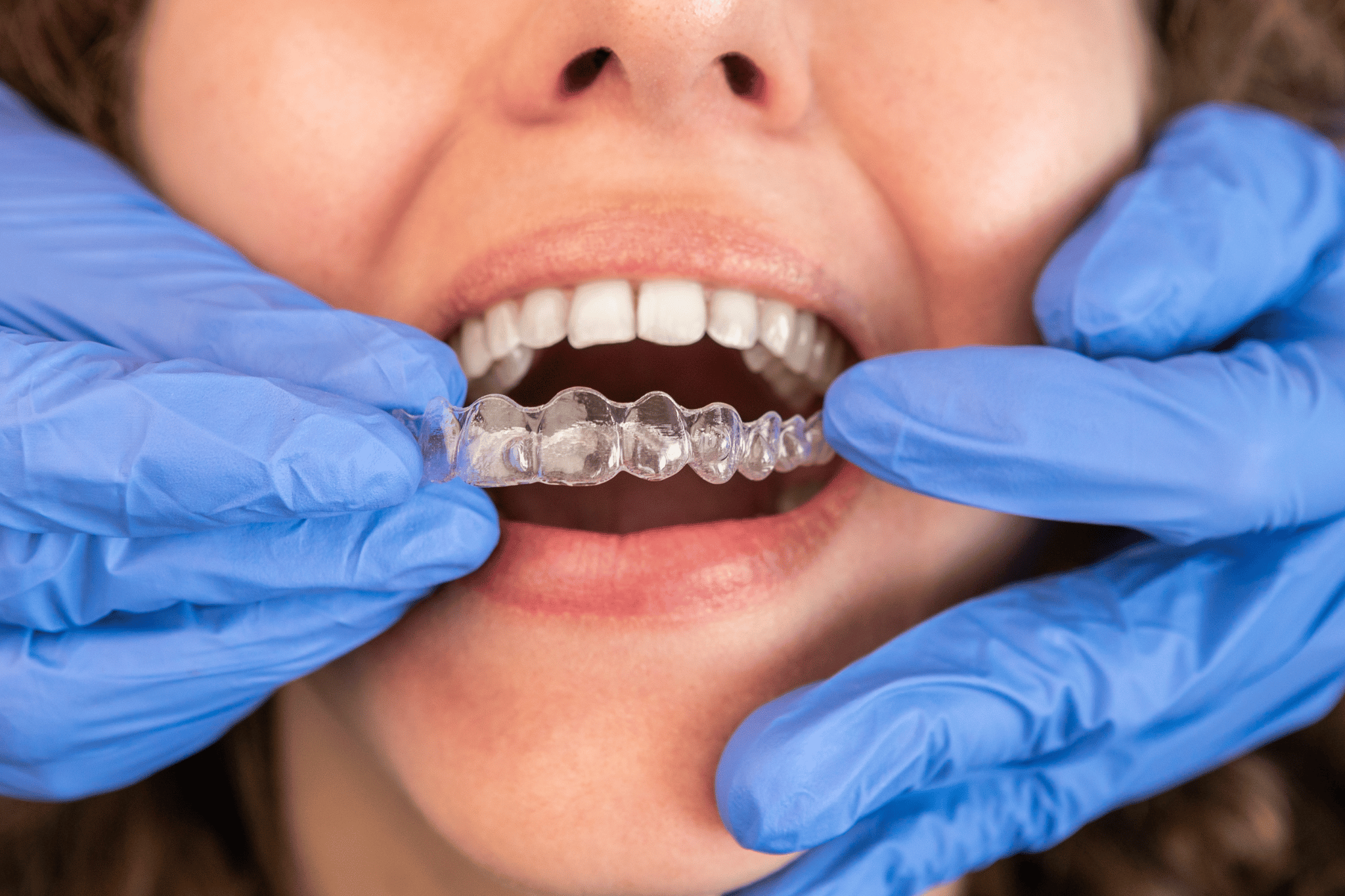 How to Find A Dentist for Invisalign