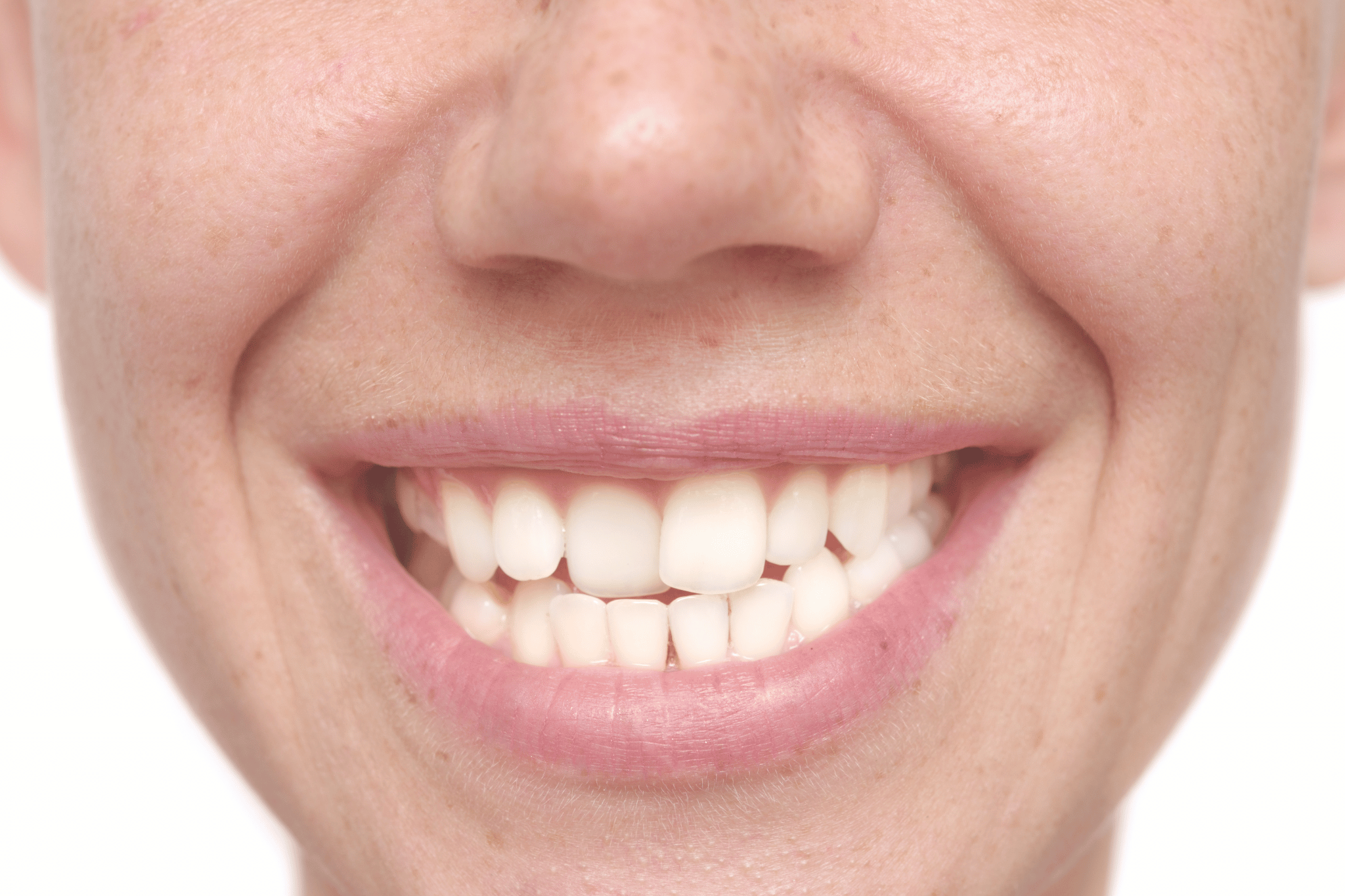Pros and Cons of Invisalign vs. Braces
