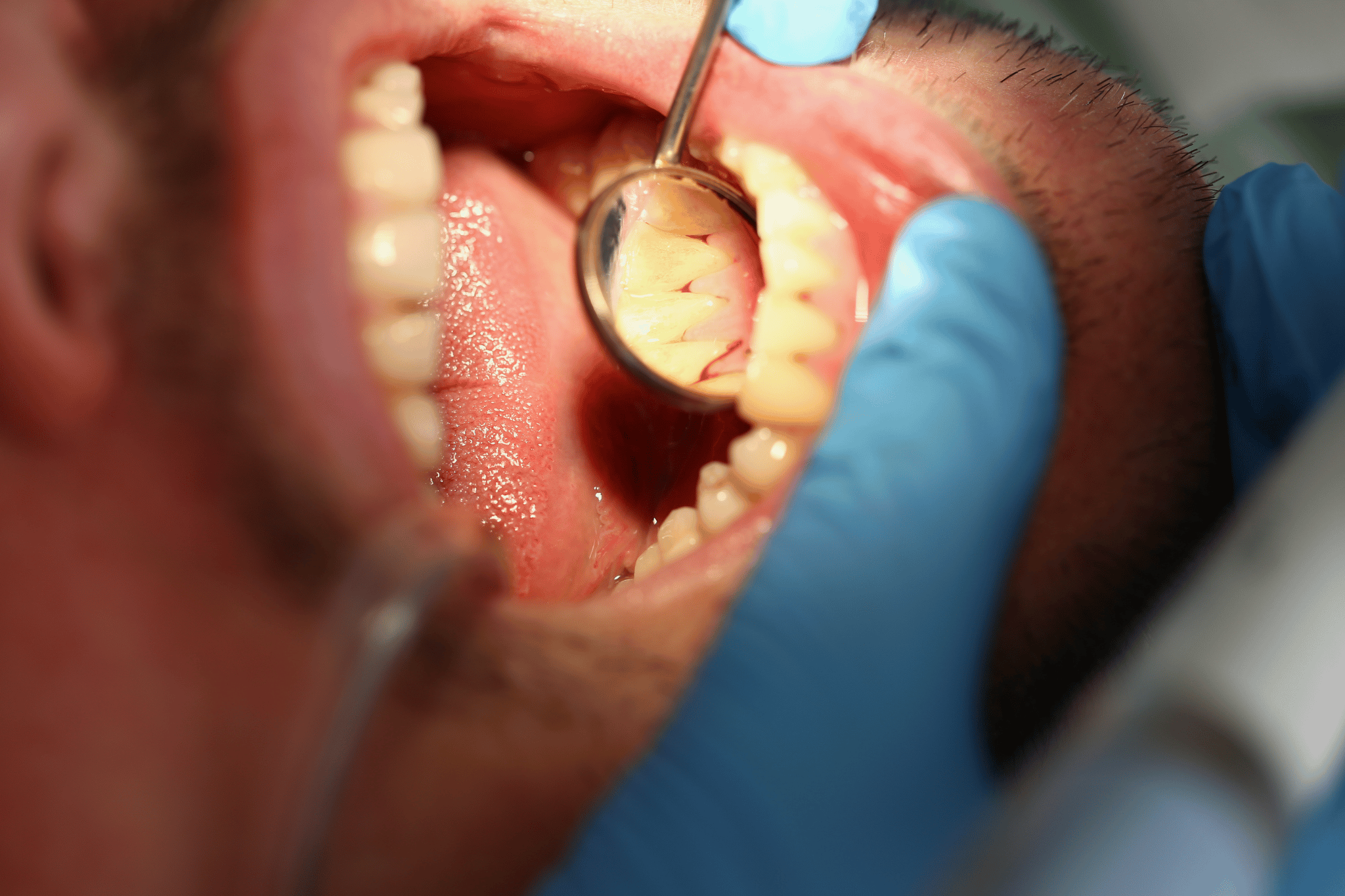 Common Causes of Bleeding Gums