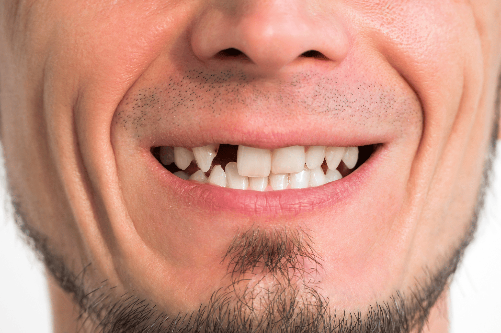 Dental Bridge vs. Implant: How to Choose