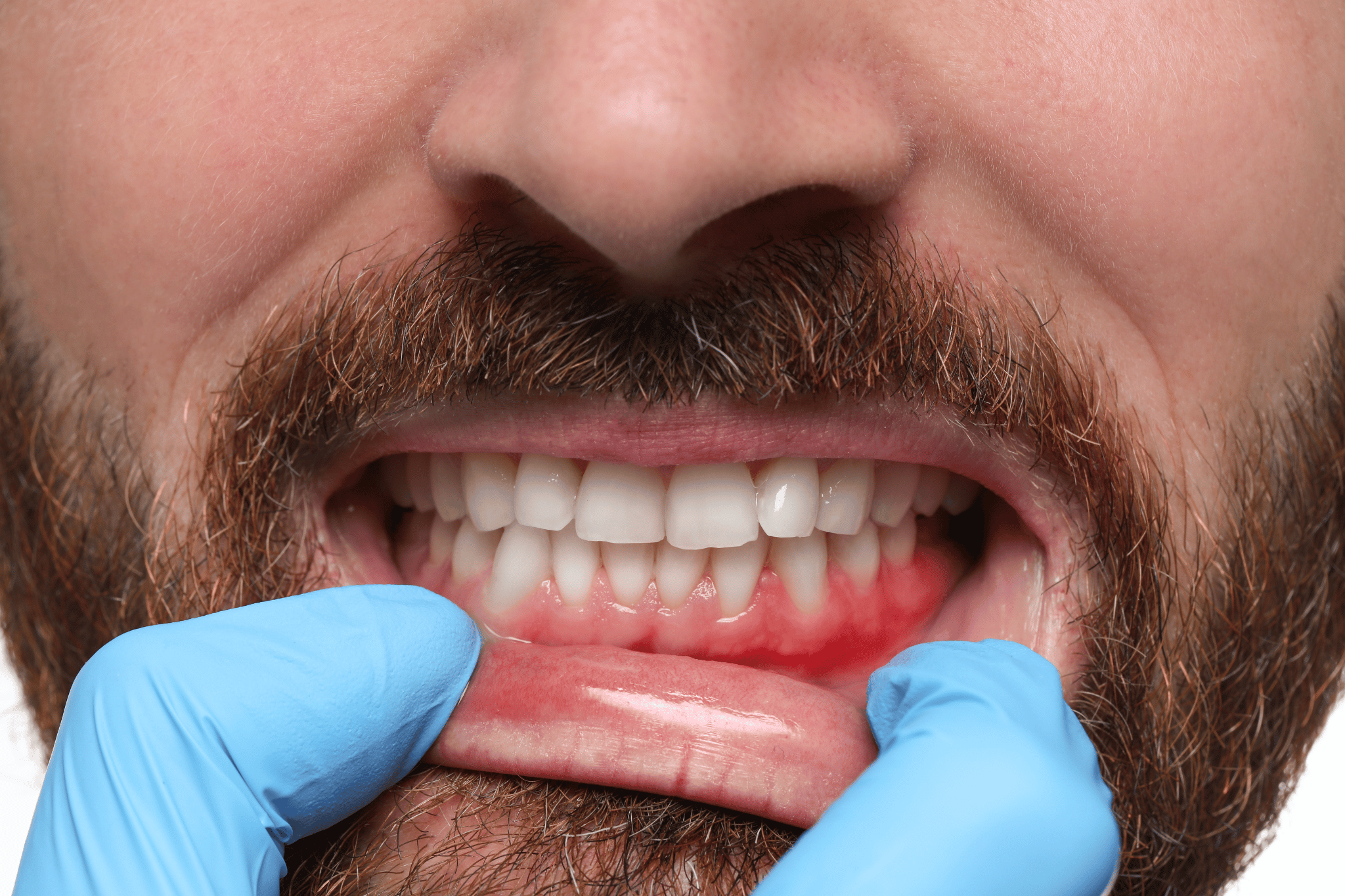 Early Warning Signs of Gum Disease