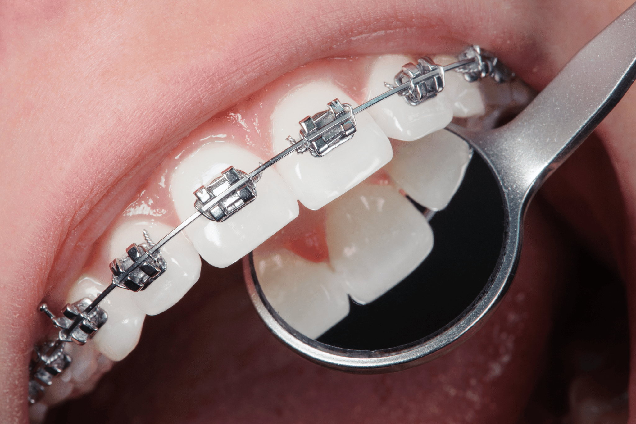 Invisalign vs. Braces: What to Know