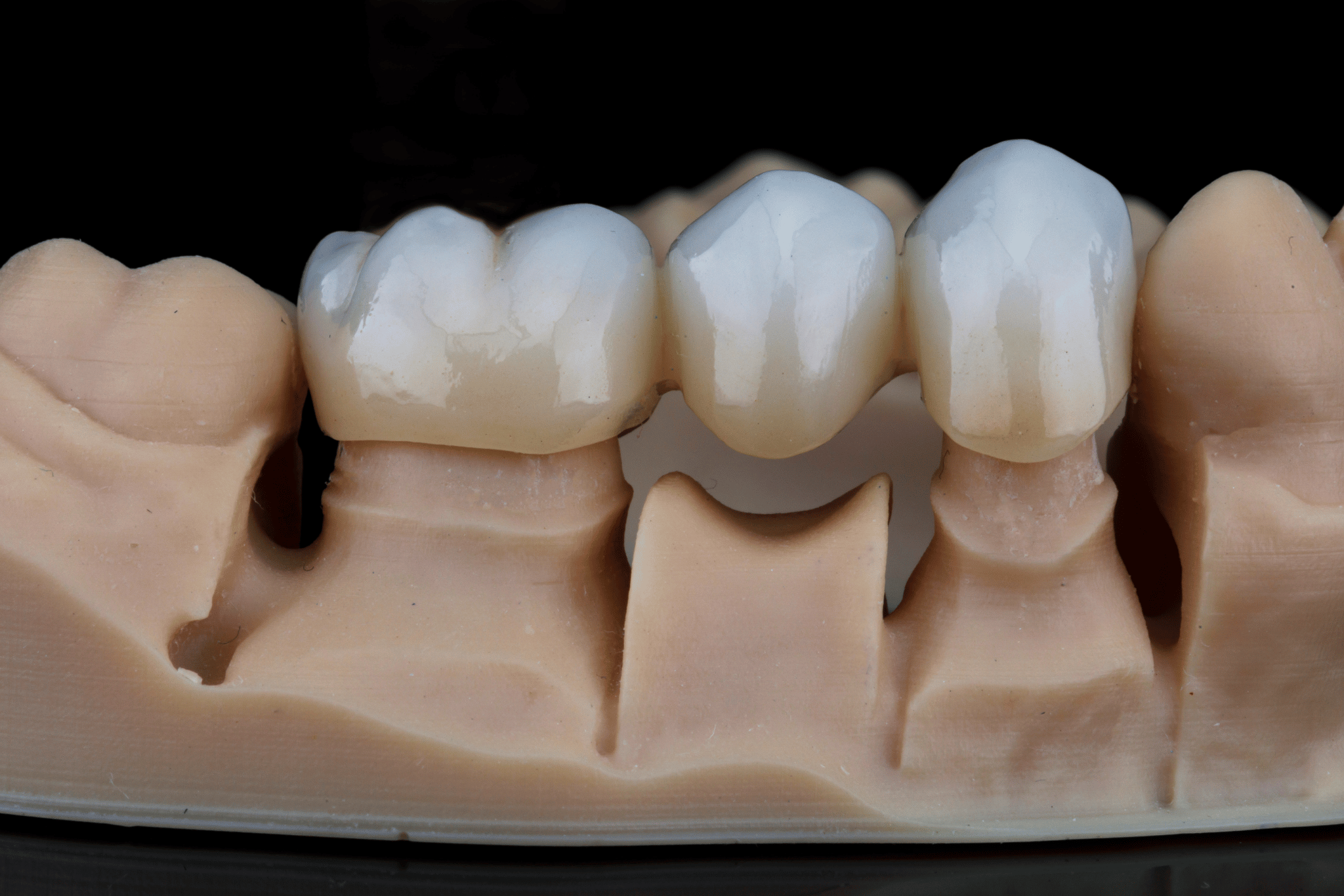 Dental Bridge vs. Implant Cost: What to Expect