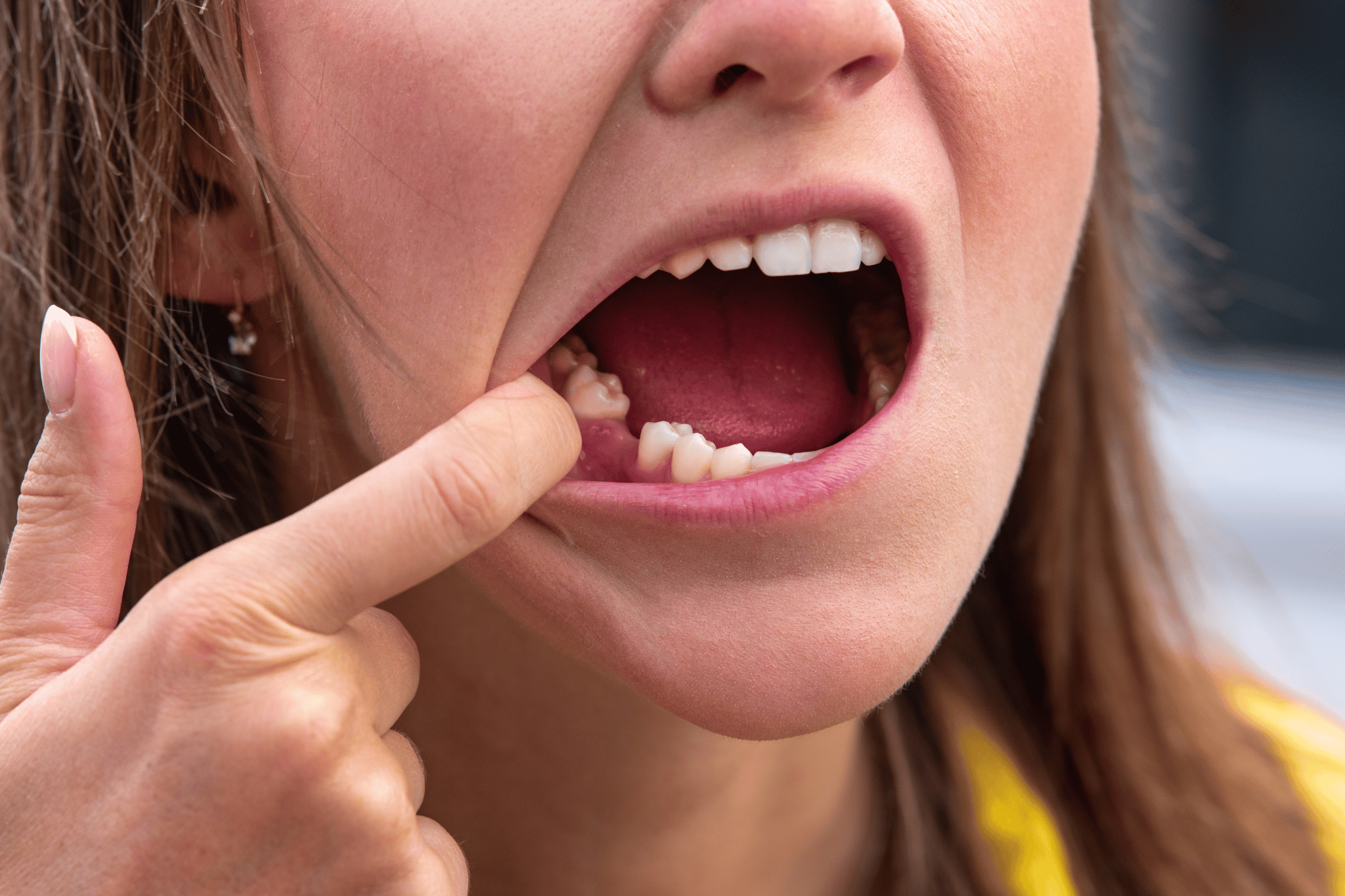 How Long Does Tooth Extraction Healing Take?