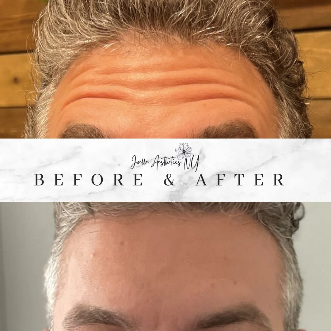 Botox for Men: Why “Bro-Tox” Is on the Rise