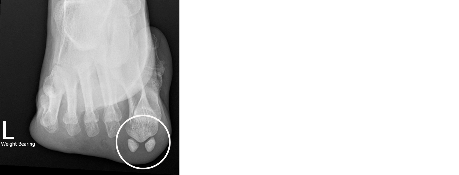 Pain under the big toe joint? It might be your Sesamoids. — Foot & Ankle