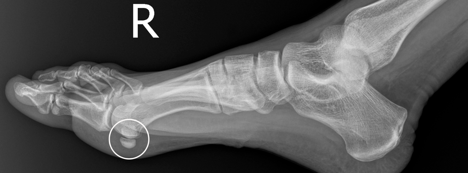 Pain under the big toe joint? It might be your Sesamoids. — Foot & Ankle