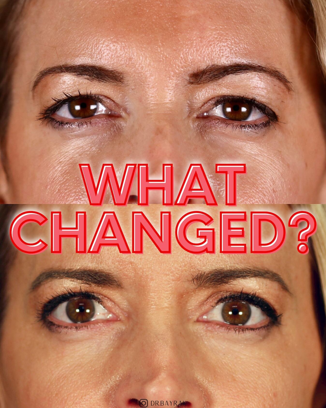 Small pop quiz to start off the week&hellip; What changed here? Something is different, but can you tell what? Comment below with your best guess! 👇🏼
&bull;
&bull;
&bull; 
Want to chat more with a facial plastic surgeon? Visit bayrakmd.com or click