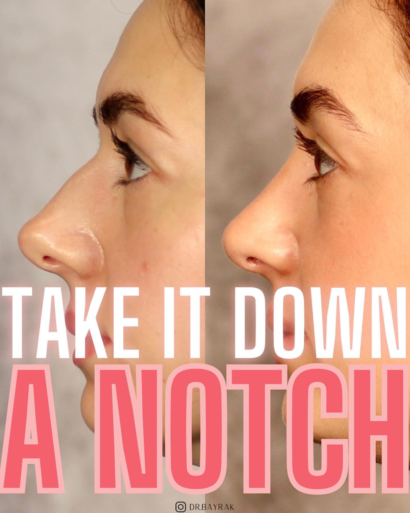 Hump got you down? 👃🏼 Via a surgical rhinoplasty, elements of the nasal structure (in this case, a dorsal hump) can be addressed to create a more refined, feminine appearance to the nose. The goal is a result that is elegant, natural, and complemen