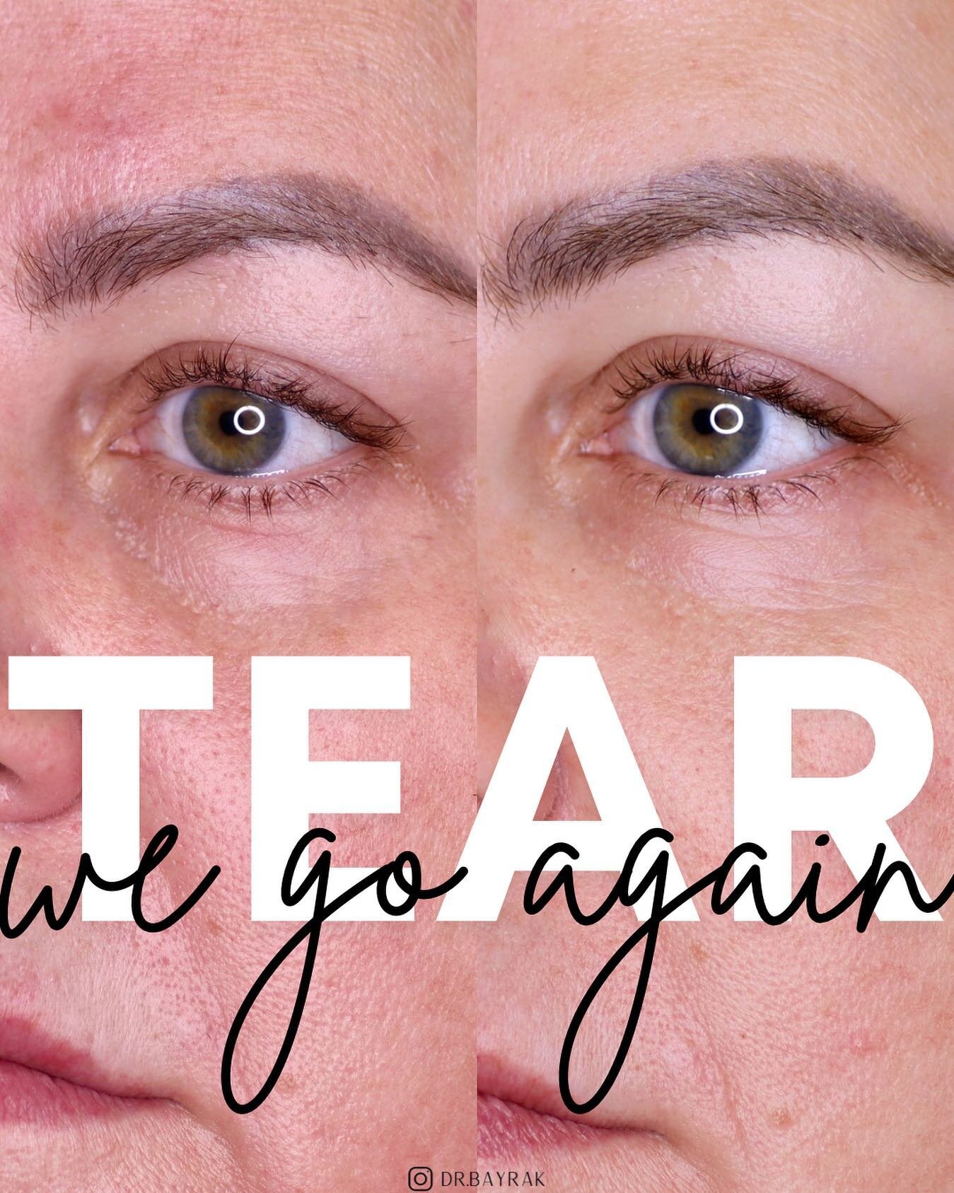 Interested in brightening up your under eye area? 👀 Depending on your individual anatomy, you may be a good candidate for non-surgical treatment like under eye filler. By filling the valley that can develop with the descent of your mid face (thanks,