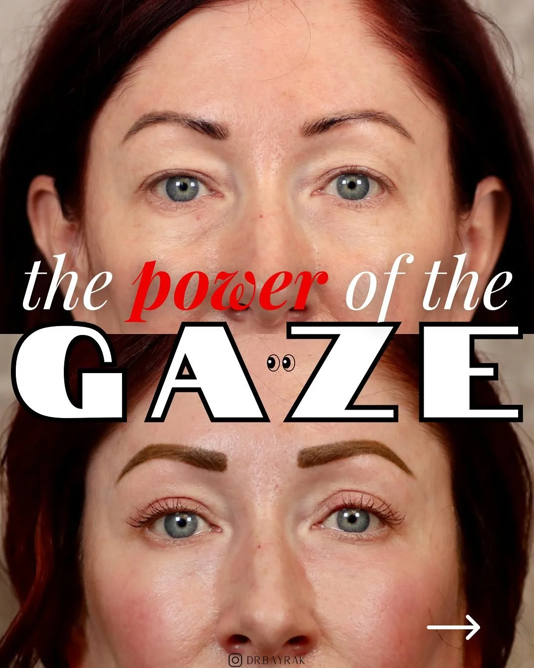 Tired eyes age you faster than wrinkles. This patient had upper and lower blepharoplasty with fat transfer and CO2 laser to smooth under-eye bags, lift heavy lids, and restore a refreshed gaze. Eyelid surgery isn&rsquo;t about changing your face &mda