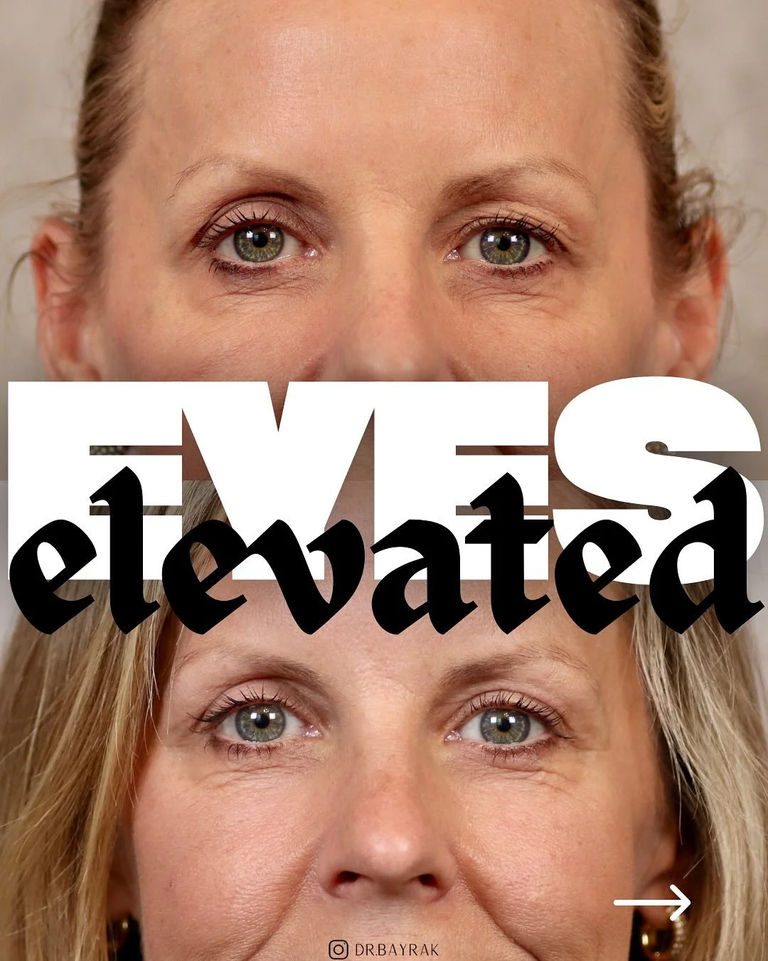 An upper blepharoplasty or upper eyelid lift can open the eyes, soften heaviness, and restore a refreshed, natural look &mdash; all while keeping your features uniquely you. Same eyes, brighter outlook. 👀
&bull;
&bull;
⚕️Procedure: Upper blepharopla