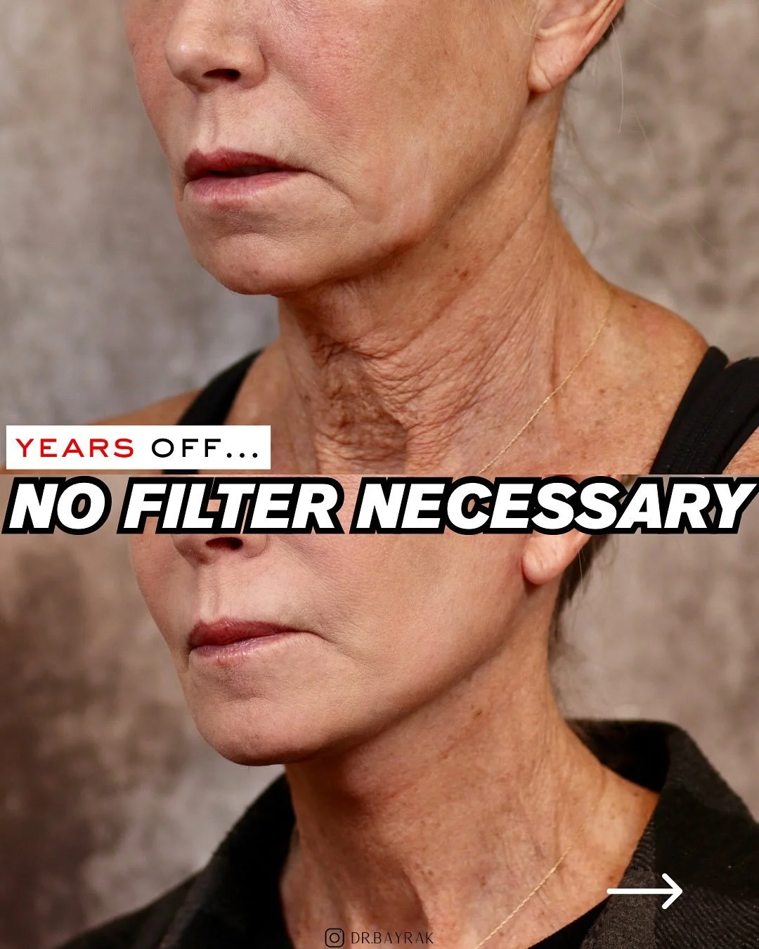 Years off with zero filters. This is what happens when gravity meets its match. 🥊

A deep-plane face and neck lift repositions the deeper layers of the face and releases key ligaments, doing much more than tightening skin. It restores youthful struc
