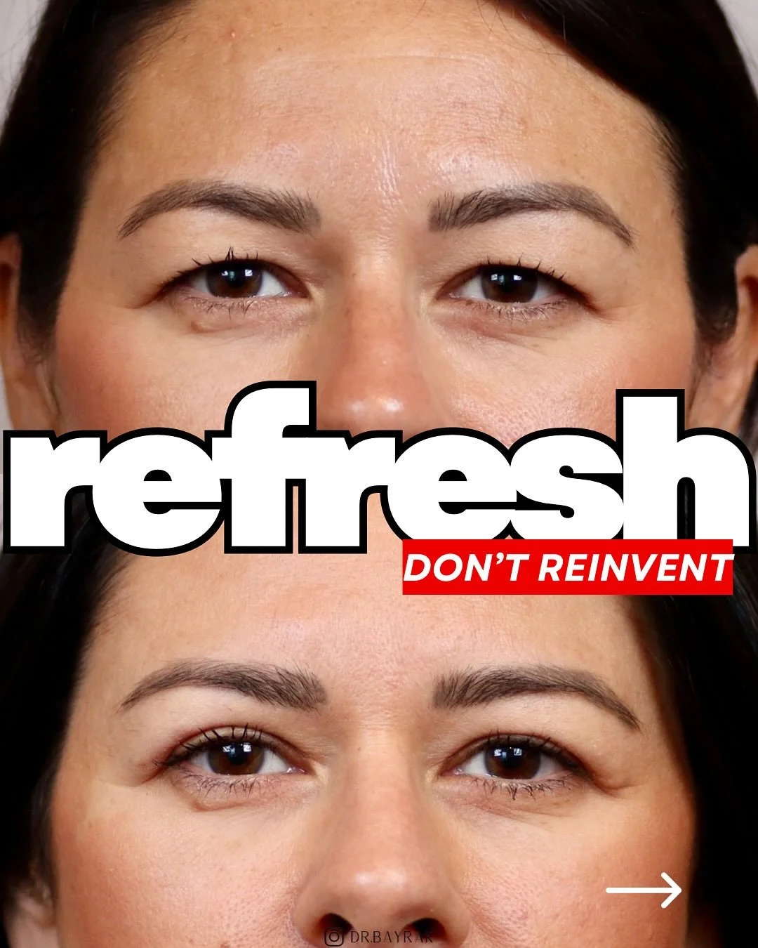 Some eyes are born with a hooded shape. 👀 This patient loved that part of her anatomy, but she wanted the heaviness and extra skin gone. That&rsquo;s where an upper bleph works well. By opening the eyes without changing their character, a small lift