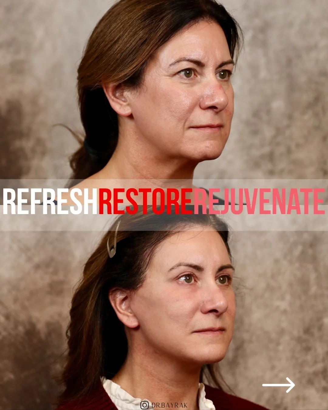 When we treat 1️⃣ structure, 2️⃣ volume, and 3️⃣ skin quality together, everything works in harmony. This patient had a brow lift, upper blepharoplasty, extended deep-plane face and neck lift, fat transfer, and CO2 laser resurfacing. Together, these 