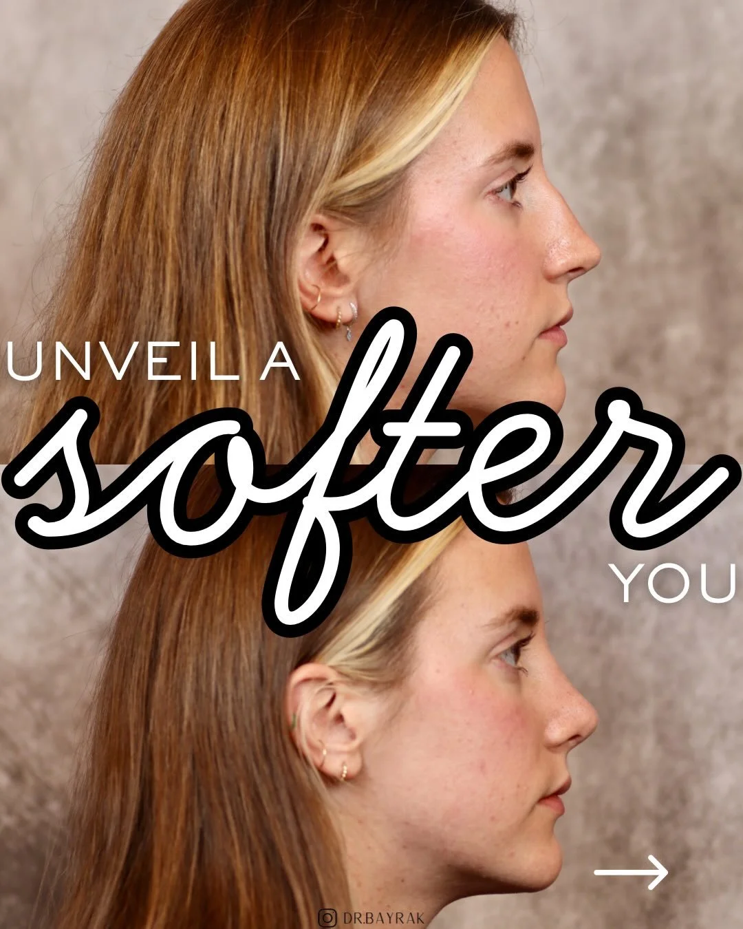 Soft doesn&rsquo;t mean boring. It means thoughtful, intentional rhinoplasty. 👃🏼

For this result, I focused on smoothing the nasal bridge, refining the tip, and improving facial balance without changing who she is. Same nose, same face, just more 