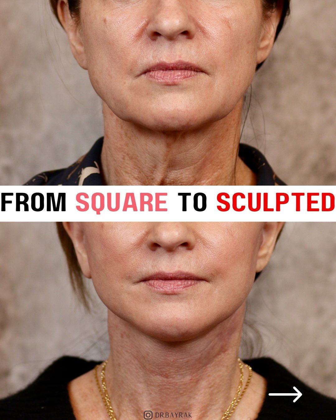 Aging doesn&rsquo;t just loosen skin, it changes facial shape ◼️. The lower face widens, jowls form, and the jawline loses definition as the youthful inverted triangle fades 🔻. A deep plane facelift works at the structural level, repositioning deepe