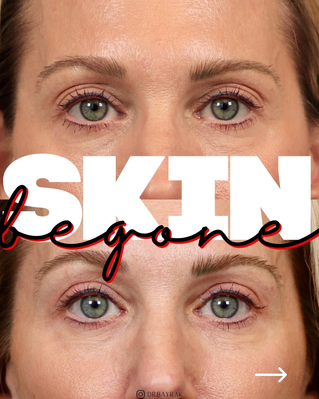Upper blepharoplasty is one of the most effective yet understated facial procedures when done correctly. By removing excess upper eyelid skin and restoring a natural eyelid crease, this surgical eyelid lift opens the eyes without changing their shape