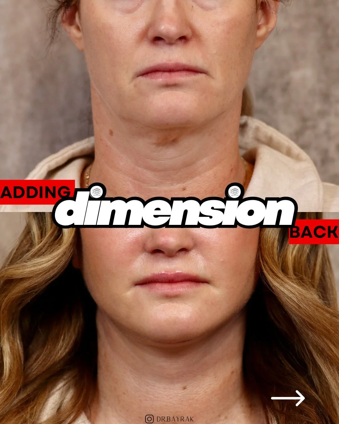 As we age, gravity pulls the soft tissues of the face downward and forward, causing fat, muscle, and skin to collect and blur together. This is why the jawline softens, cheeks flatten, and the neck loses definition, masking the underlying facial stru