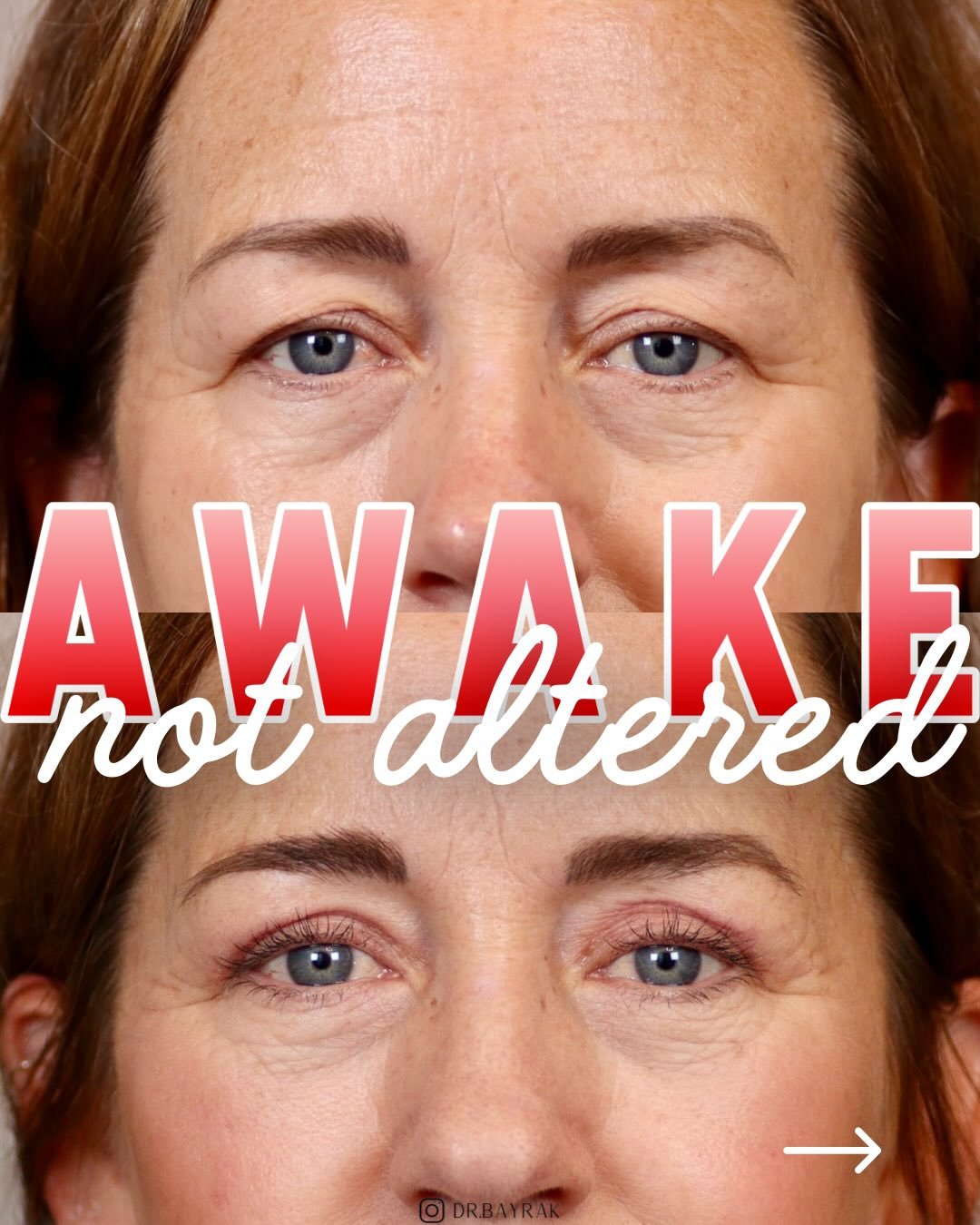 Upper blepharoplasty is a simple, in-office procedure that removes excess eyelid skin without changing the eyes. Her shape and expression are the same; there&rsquo;s just less weight on the lids. When that heaviness is gone, the eyes naturally look m