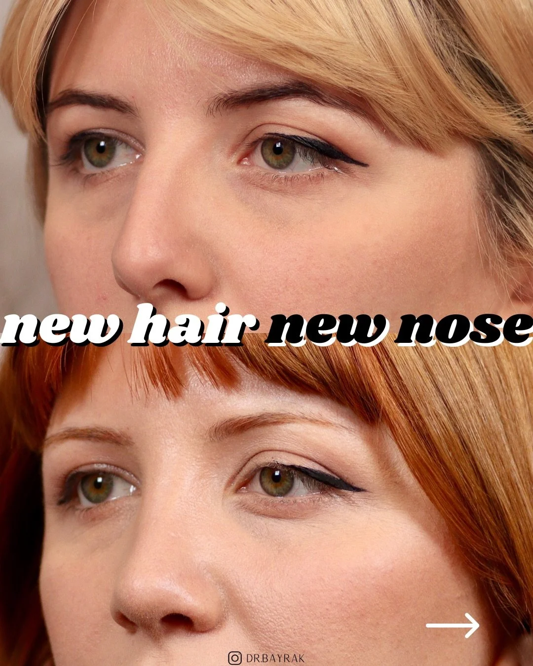 A new hair color should be obvious, but a good rhinoplasty shouldn&rsquo;t. It should just make everything else make more visual sense.
&bull;
&bull;
⚕️ Procedure: Rhinoplasty
💉Anesthesia: General anesthesia
🤕Downtime: 1-2 weeks
&bull;
&bull;
Want 