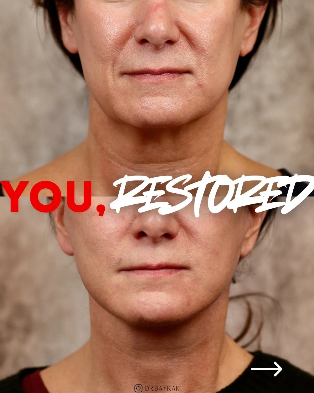 When you address structure, volume, and skin quality together, everything settles back into a more rested, smoother version of itself without changing who someone is. This before and after of a deep plane face and neck lift with fat transfer and CO2 