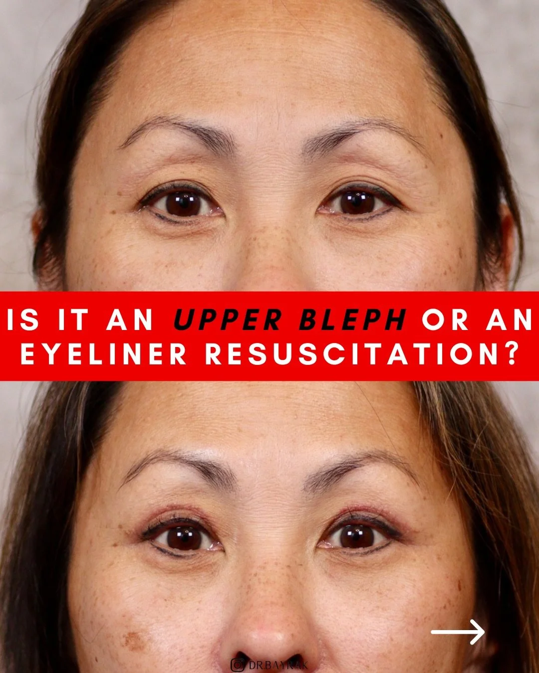 Upper blepharoplasty can do more than just remove excess skin. In this patient&rsquo;s case, restoring the natural eyelid contour revived her old semi-permanent eyeliner, which had been hiding under hooded skin for years. Same eyes and make-up, just 