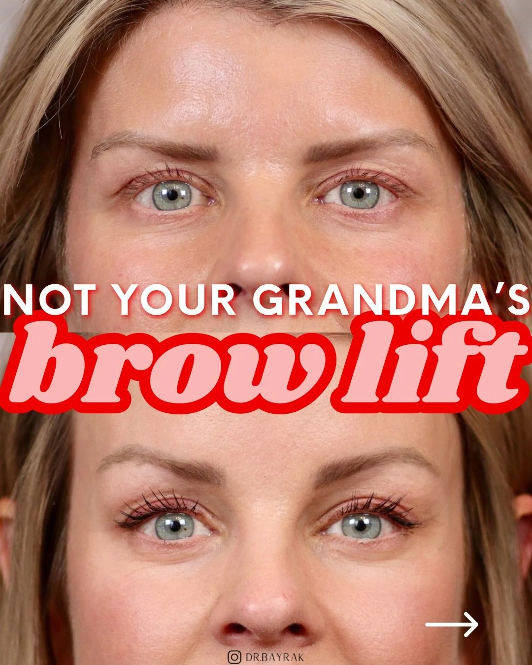 A low brow and excess upper lid skin can make the eyes look smaller, heavier, and more tired, but the truth is, a well-executed brow lift can be the secret ingredient to a refreshed, rejuvenated appearance. For this beautiful patient, an endoscopic b