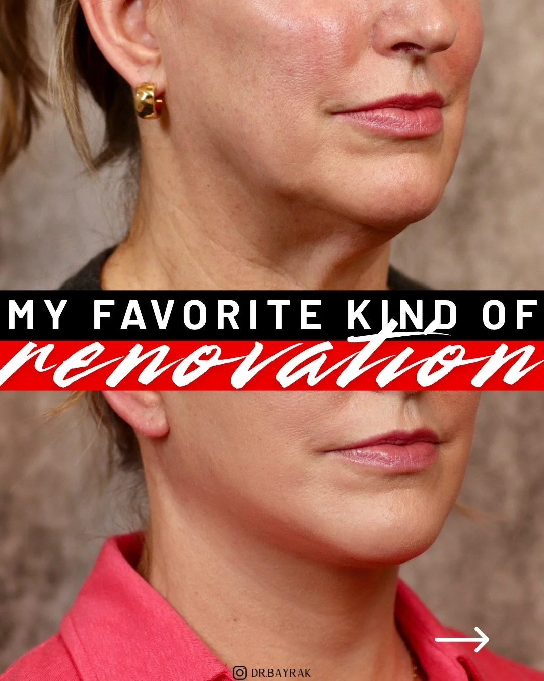 My favorite kind of renovation is the kind that doesn&rsquo;t look like work was done. This was an extended deep-plane face and deep neck lift, meaning the lift happens at the structural level and not just the skin. The jawline is sharper, the neck i