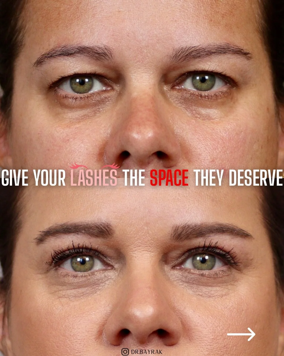 As we get older, our upper eyelids can gradually crowd the lash line as skin begins to drape downward and forward. An upper blepharoplasty (like this one!) restores that space so the lashes and natural eye shape can show up again. 👀
&bull;
&bull;
⚕️