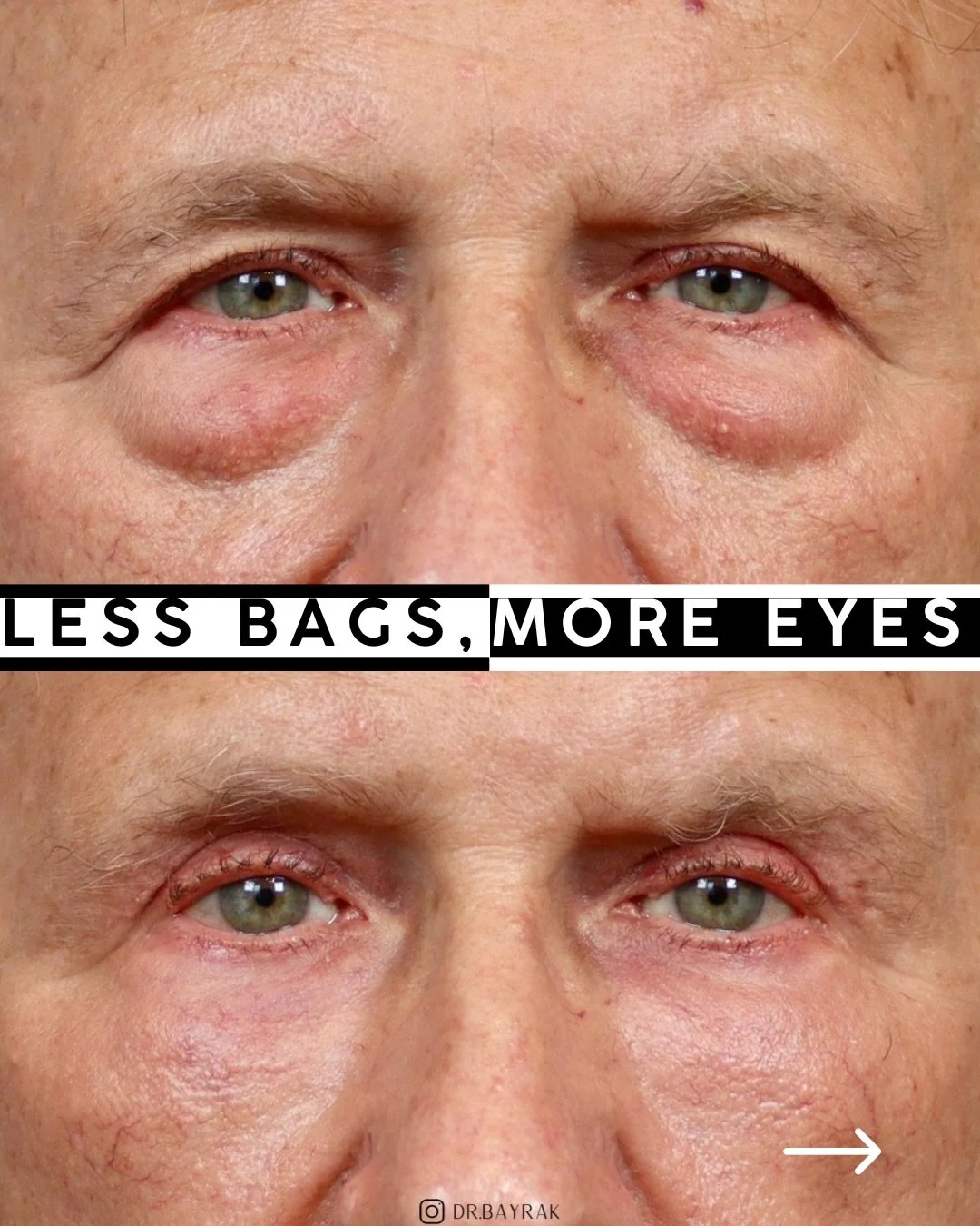 Herniated lower eyelid fat doesn&rsquo;t respond to creams, sleep, or wishful thinking. An upper and lower blepharoplasty addressed the excess skin and fat, fat transfer softened the tear trough, while CO2 laser tightened the skin quality. Same eyes,