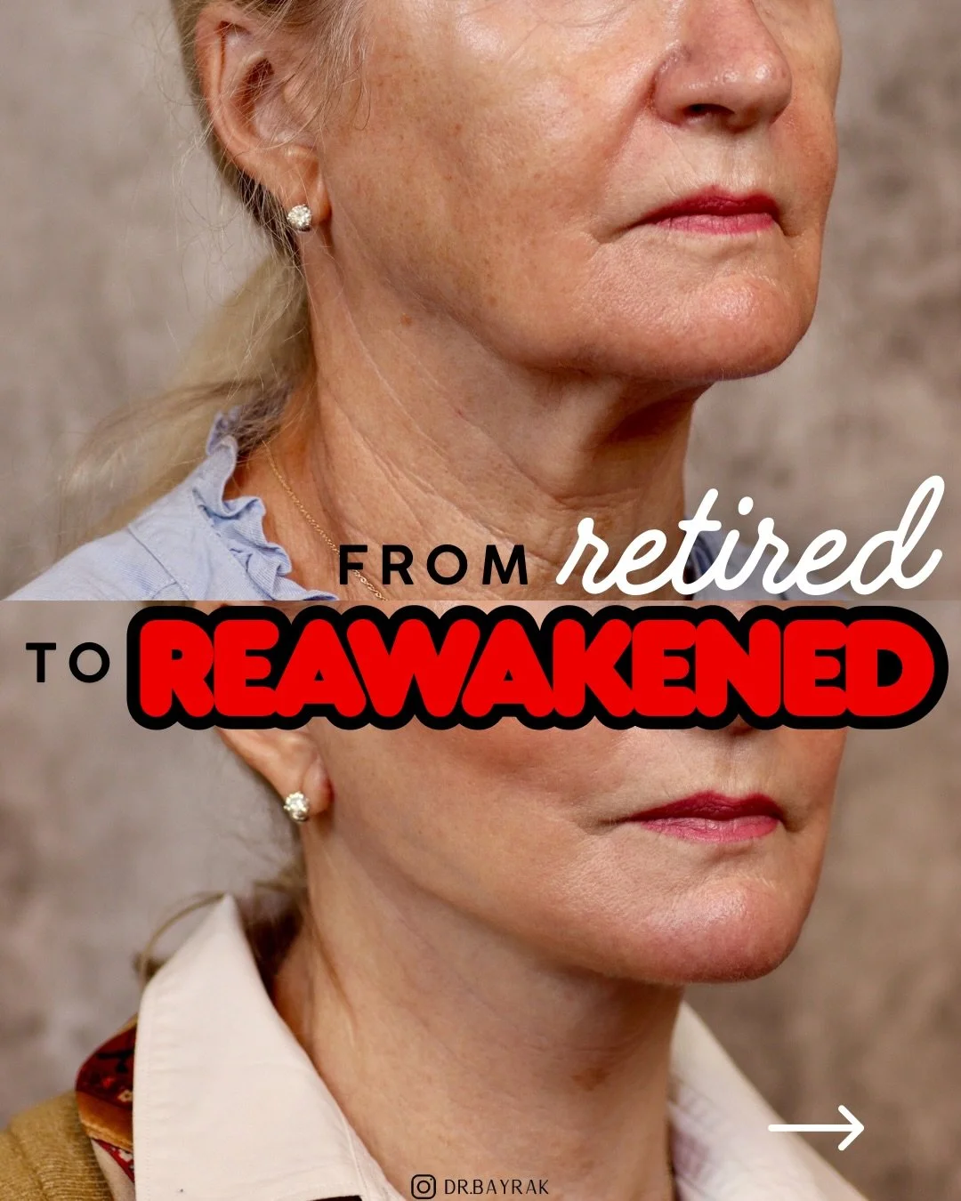A deep plane face and neck lift repositions the deeper structures ✅, fat transfer restores volume where it has been lost ✅, and CO2 laser improves overall skin quality ✅. When each layer is addressed deliberately, the result is balanced and seamless.