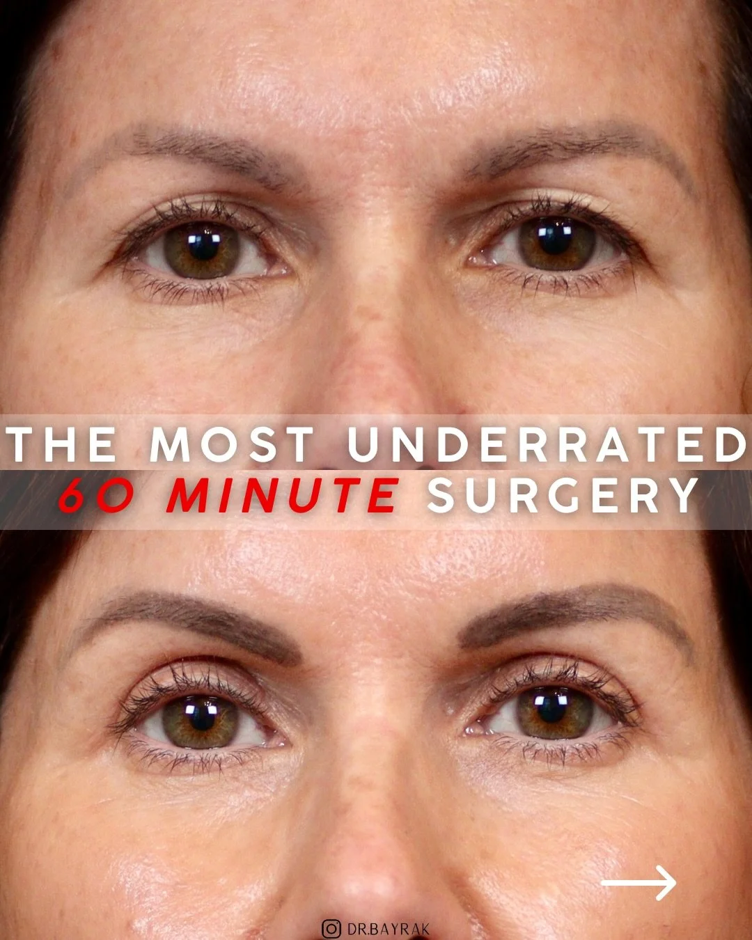 Upper blepharoplasty might be the most underrated 60 minutes in surgery.

If your upper eyelids have started to feel heavy or if they look like they&rsquo;re slowly closing in on you, this is worth knowing about. An upper blepharoplasty removes exces