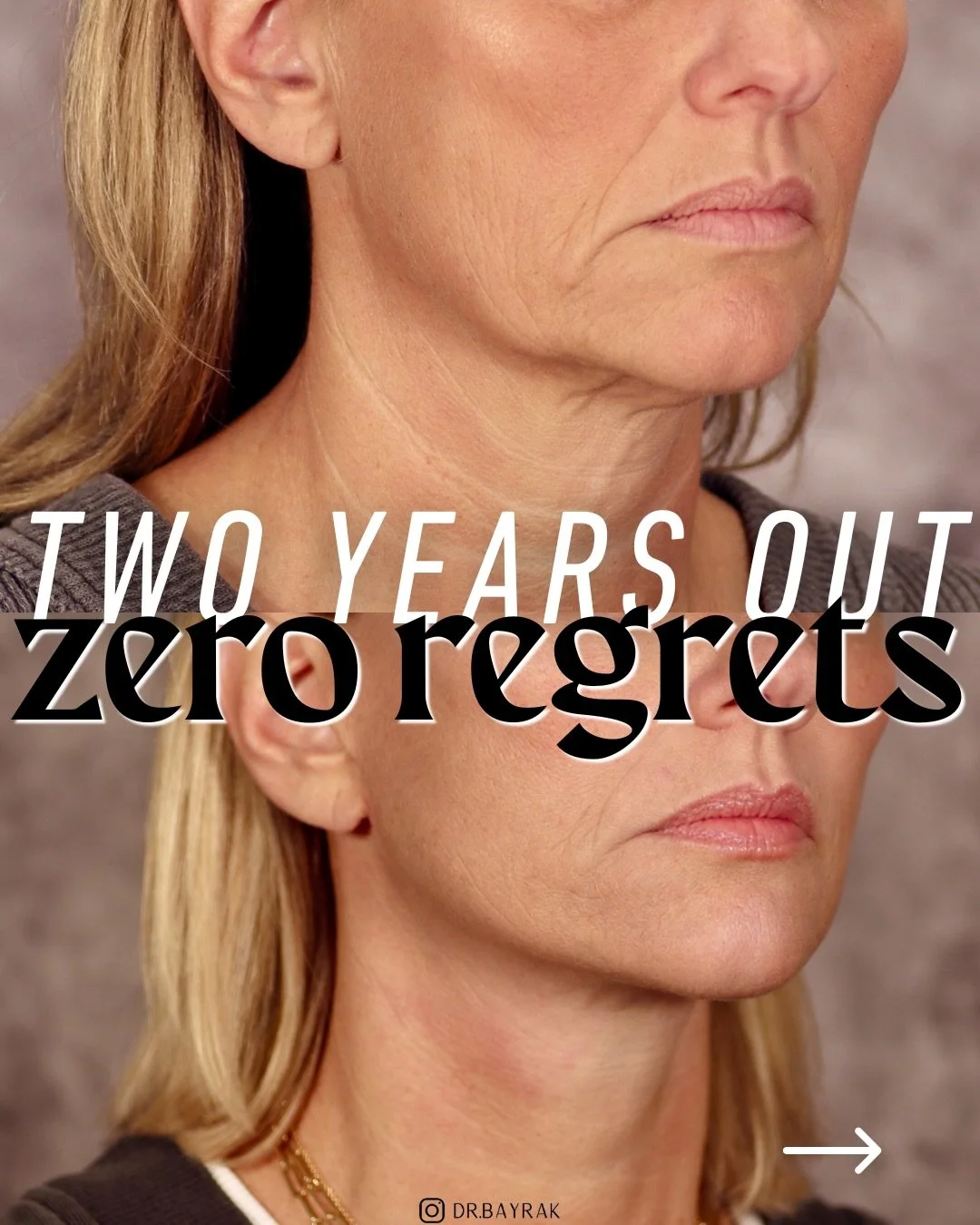 Two years post-op, and nobody&rsquo;s guessing she had surgery. That&rsquo;s the point.

The extended deep plane lift works at a deeper anatomical layer than a traditional facelift. It repositions the actual muscle and tissue structure rather than ju