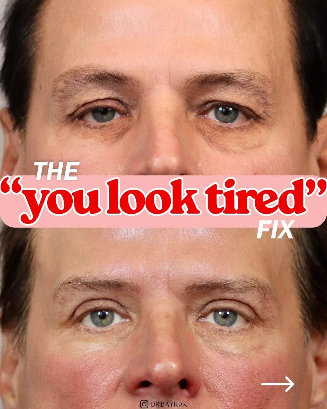 &ldquo;I think I&rsquo;m one of your best results.&rdquo; His words, not mine &mdash; and honestly, he might have a case. He came in saying he always looked tired, and he left with upper eyelids. Upper blepharoplasty removes the excess skin that hood