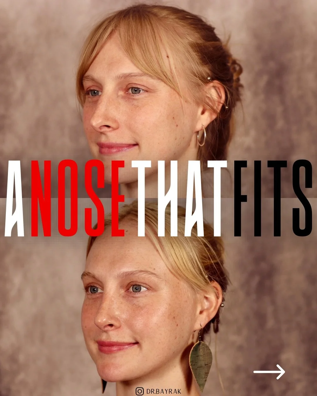 The goal was never a &ldquo;new nose.&rdquo; It was balance. Swipe to see how refining the tip and dorsum let the rest of her face do the talking. Results like this don&rsquo;t shout &mdash; they just fit. 👃🏼

🔗 Comment &ldquo;CONSULT&rdquo; below
