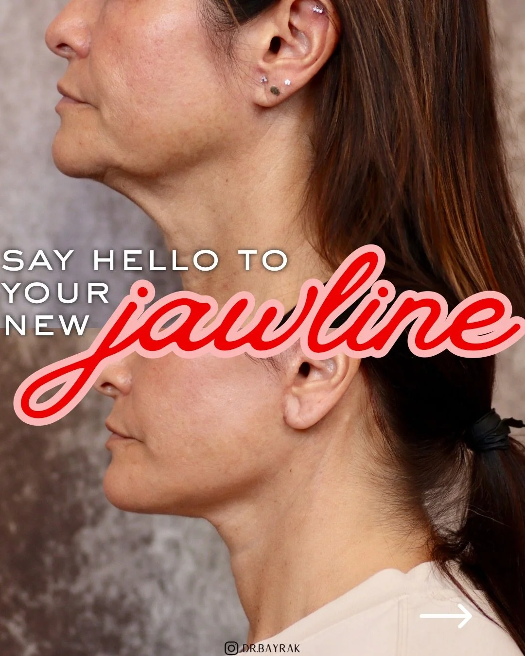 One of the biggest misconceptions about a face and neck lift is that it&rsquo;s about pulling skin tighter. It isn&rsquo;t. 

The goal is to reposition the deeper facial structures that have descended over time, restore jawline definition, improve ne