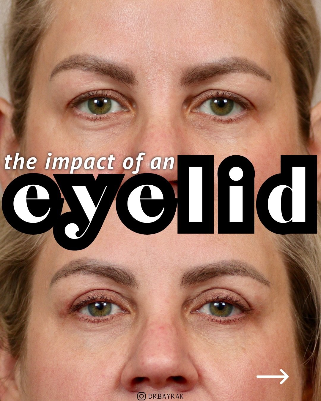 Upper blepharoplasty removes excess upper eyelid skin that causes hooding, heaviness, and a tired or aged appearance. This outpatient, in-office procedure restores the lid platform, opens the eye, and refreshes the entire upper face without changing 